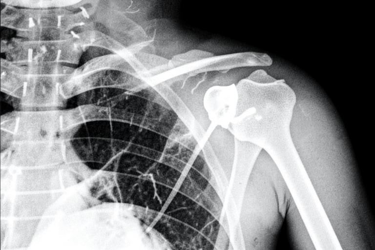Radiografía de hombro con fractura de cabeza de húmero