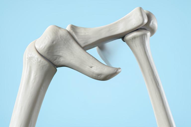 Modelo anatómico de articulación del hombro luxada